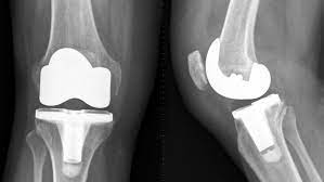 Exactech Legal cases – Trendy, Knee and Ankle Replacements Boasts post thumbnail image