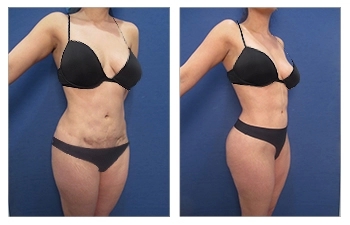 How Can Liposuction treatment Assist Extra fat Men and women? post thumbnail image