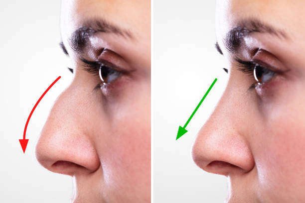 Take pleasure in wonderful benefits by hiring the assistance of Nose job Beverly Hills post thumbnail image